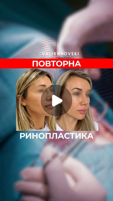 Обложка Instagram Reels о повторной ринопластике