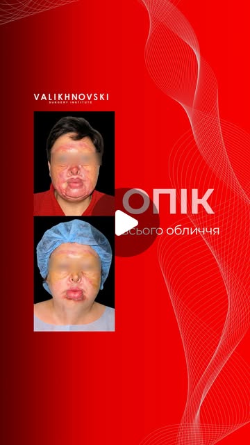 Обложка Instagram Reels о лечении ожога лица
